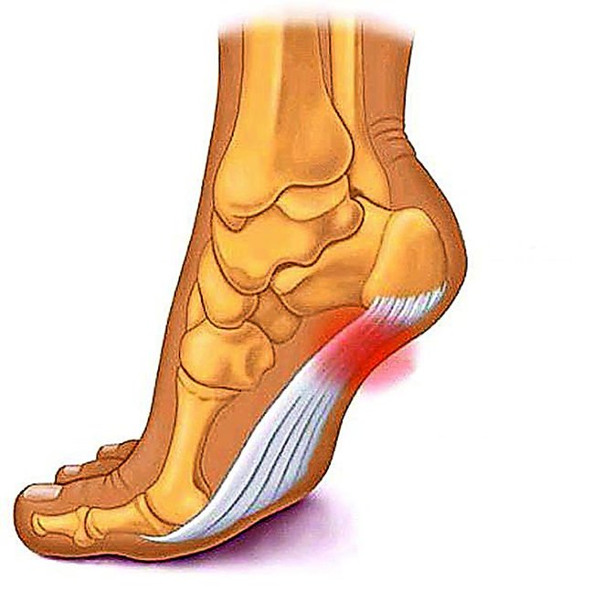 Plantarni fascitis Potek plantarne aponevroze.