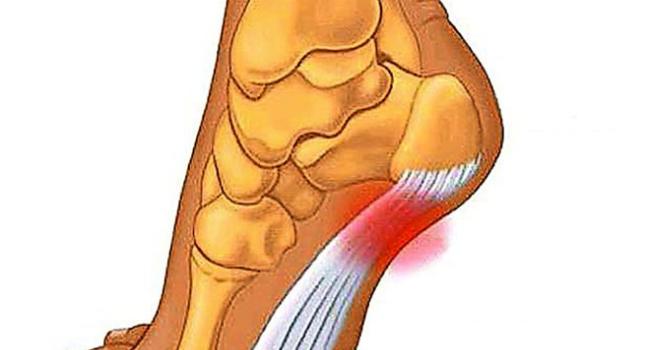 Plantarni fascitis Potek plantarne aponevroze.