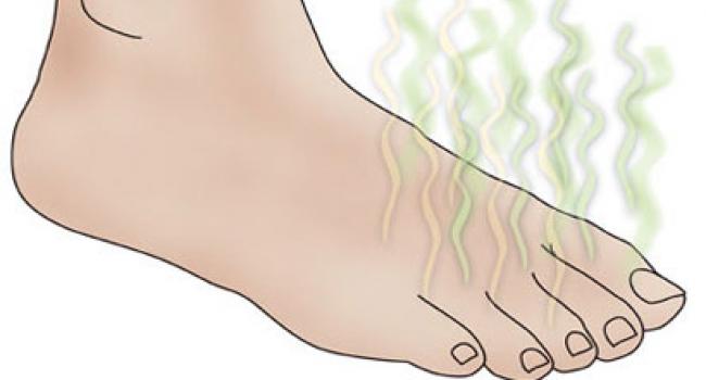 Prekomerno znojenje stopala